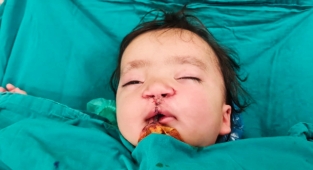 Doğuştan Dudak-Damak Yarığı Olan 9 Aylık Bebek, KSÜ Tıp’ta Sağlığına Kavuştu