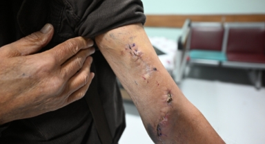 KSÜ TIP, BAŞARILI AMELİYATLARIYLA BÖLGEYE YANIT VERİYOR: ELAZIĞ’DAN GELEN 68 YAŞINDAKİ HASTAYA DİYALİZ GREFTİ TAKILDI