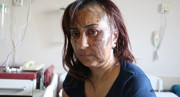 Boşanma davası açtığı kocasının kezzaplı saldırısına uğrayan kadın yaralandı
