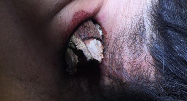 KSÜ Tıp’ta Gerçekleştirilen Ameliyatla Sağlığına Kavuştu