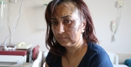 Boşanma davası açtığı kocasının kezzaplı saldırısına uğrayan kadın yaralandı