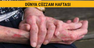 KSÜ Tıp Fakültesi 27 Ocak Cüzzam Günü Bilgilendirmesi