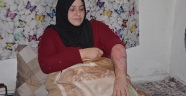 Suriyeli savaş mağduru kadın vücudundaki yanıklarla hayata tutunmaya çalışıyor