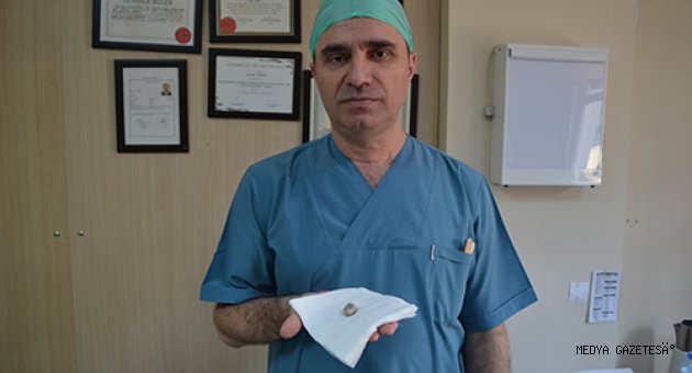 Tükürük Bezinden 3 Cm Taş Çıkartıldı!